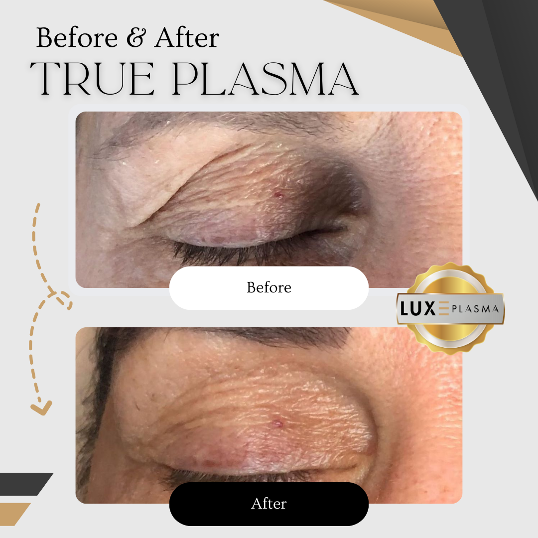 PLAXEL Plasma Pen - LUXE Edition