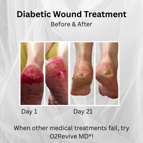 O2Revive MD™ Healing Spray (2oz)