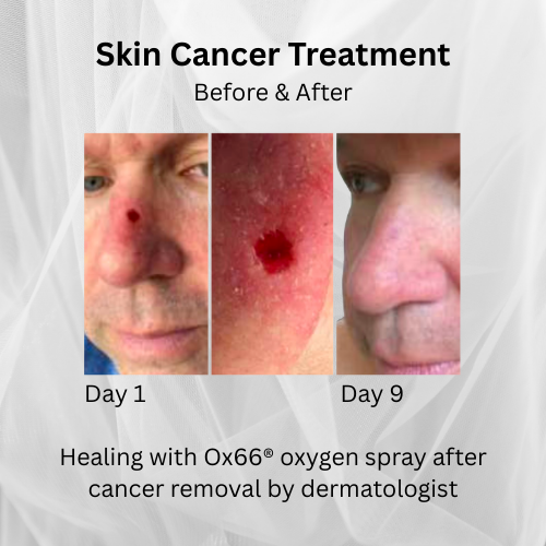 O2Revive MD™ Healing Spray (2oz)