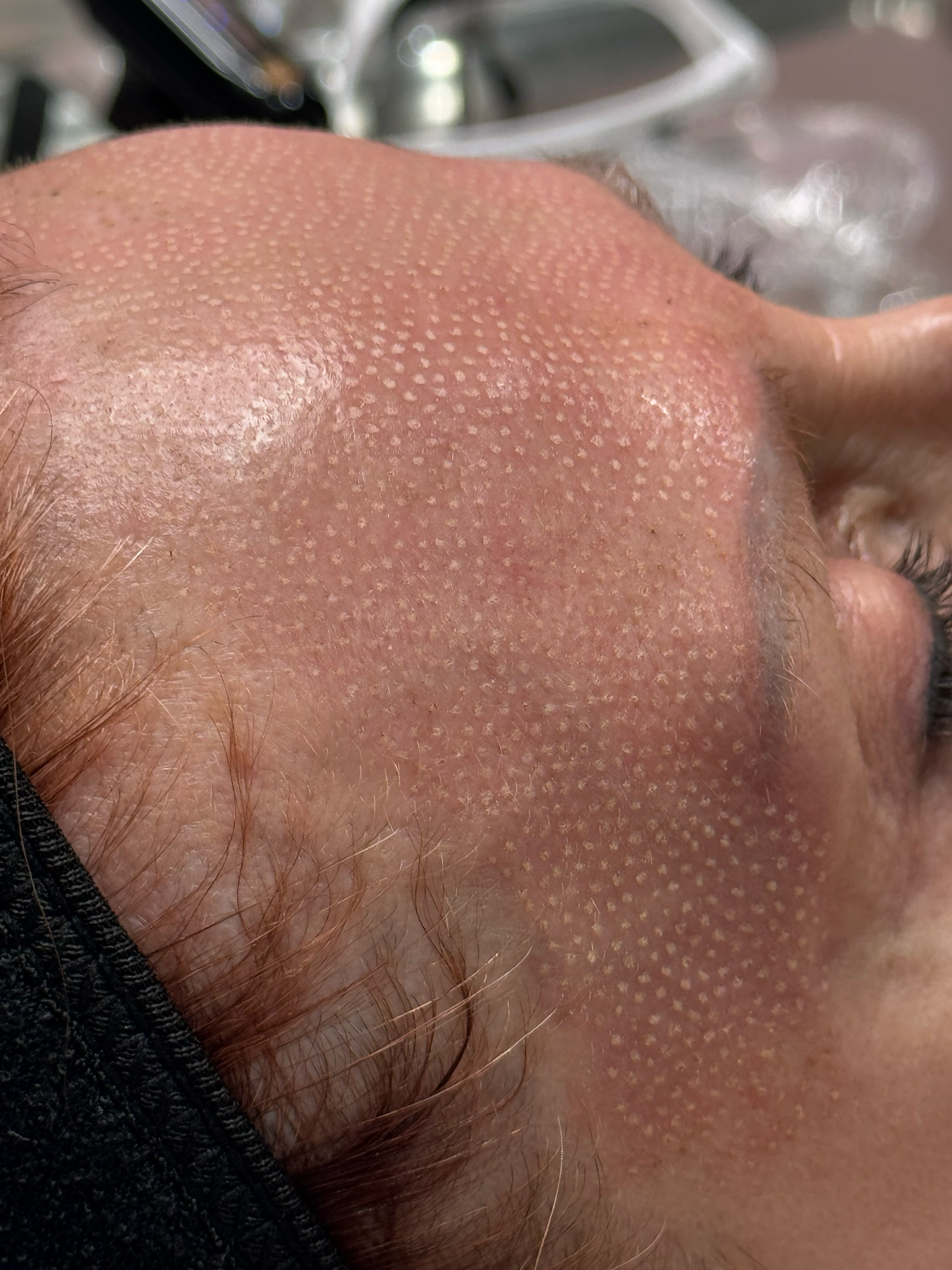 PLAXEL TruePlasma™ treatment