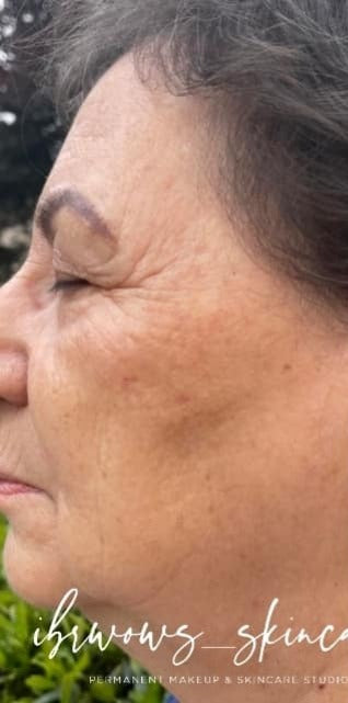 PLAXEL TruePlasma™ — full-face collagen remodeling, 1 session
