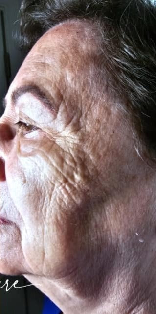PLAXEL TruePlasma™ — full-face collagen remodeling, 1 session