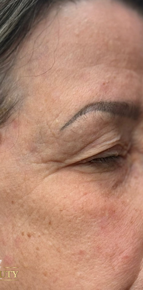 Eye lift & keratosis removal — single session
