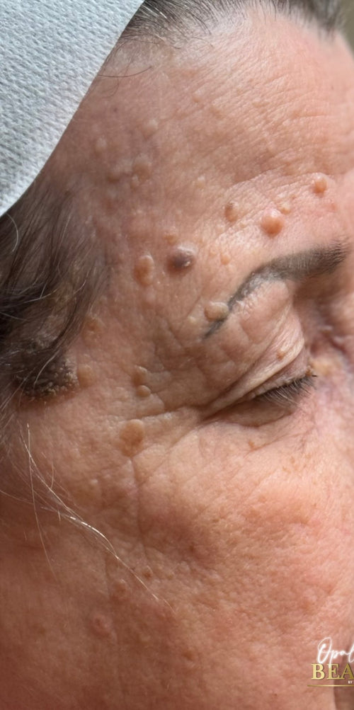 Eye lift & keratosis removal — single session