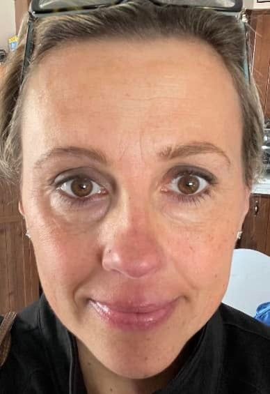 PLAXEL TruePlasma™ — full-face collagen remodeling, 1 session