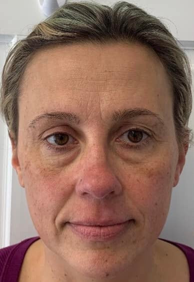 PLAXEL TruePlasma™ — full-face collagen remodeling, 1 session