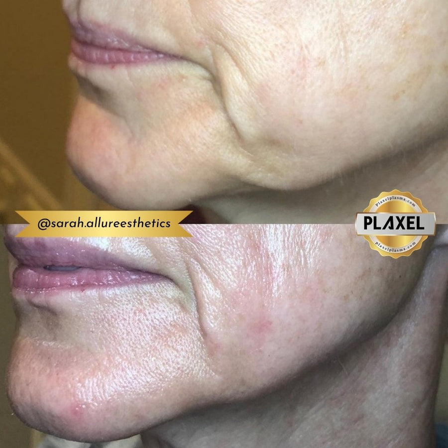 True Plasma before and after, smile lines and lower face