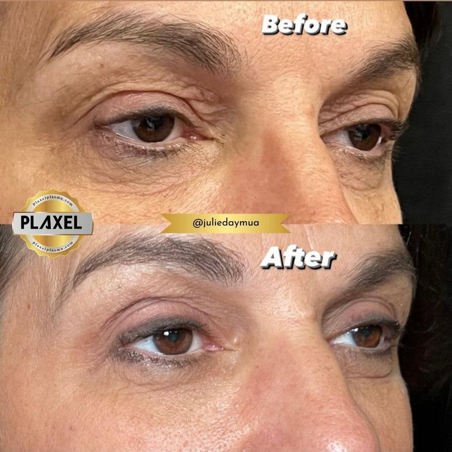 True Plasma before and after, upper eyelid, three-quarter view
