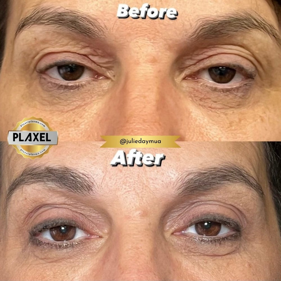 True Plasma before and after, both upper eyelids, front view