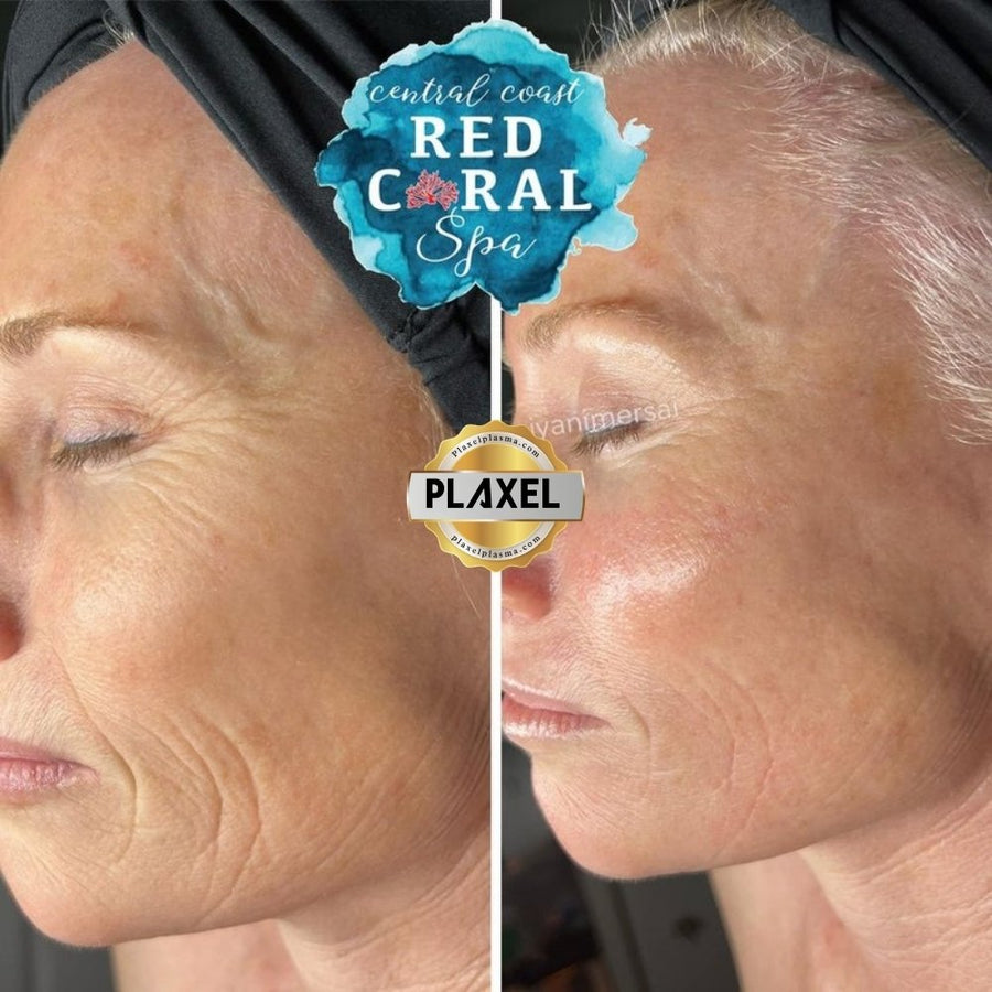 True Plasma before and after, full face, profile
