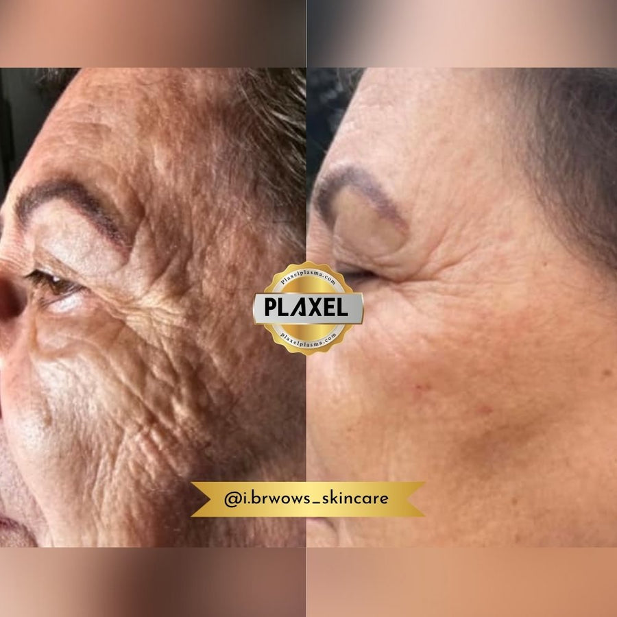 True Plasma before and after, deep lines around the eye and cheek, profile