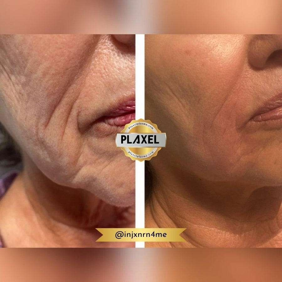 True Plasma before and after, nasolabial fold