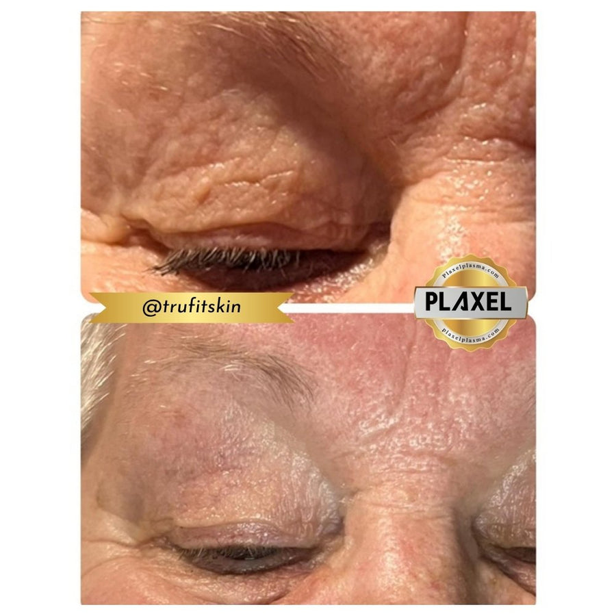 True Plasma before and after, crepey upper eyelid, close up