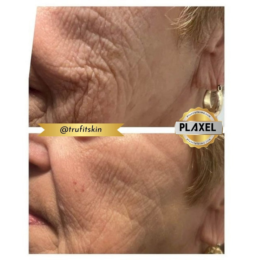 True Plasma before and after, cheek and crow’s feet
