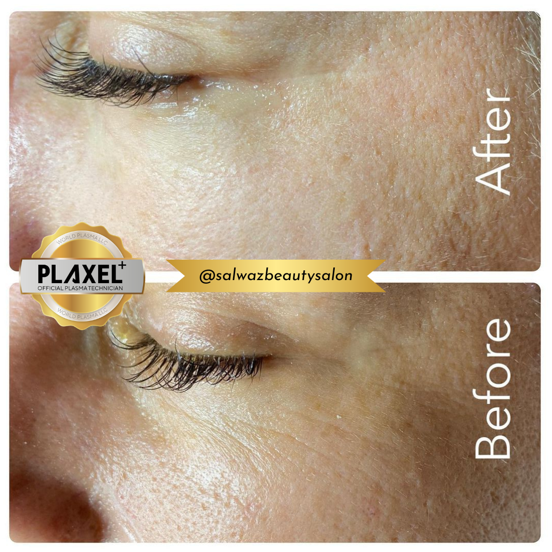 Remove fine lines and wrinkles with Plaxel