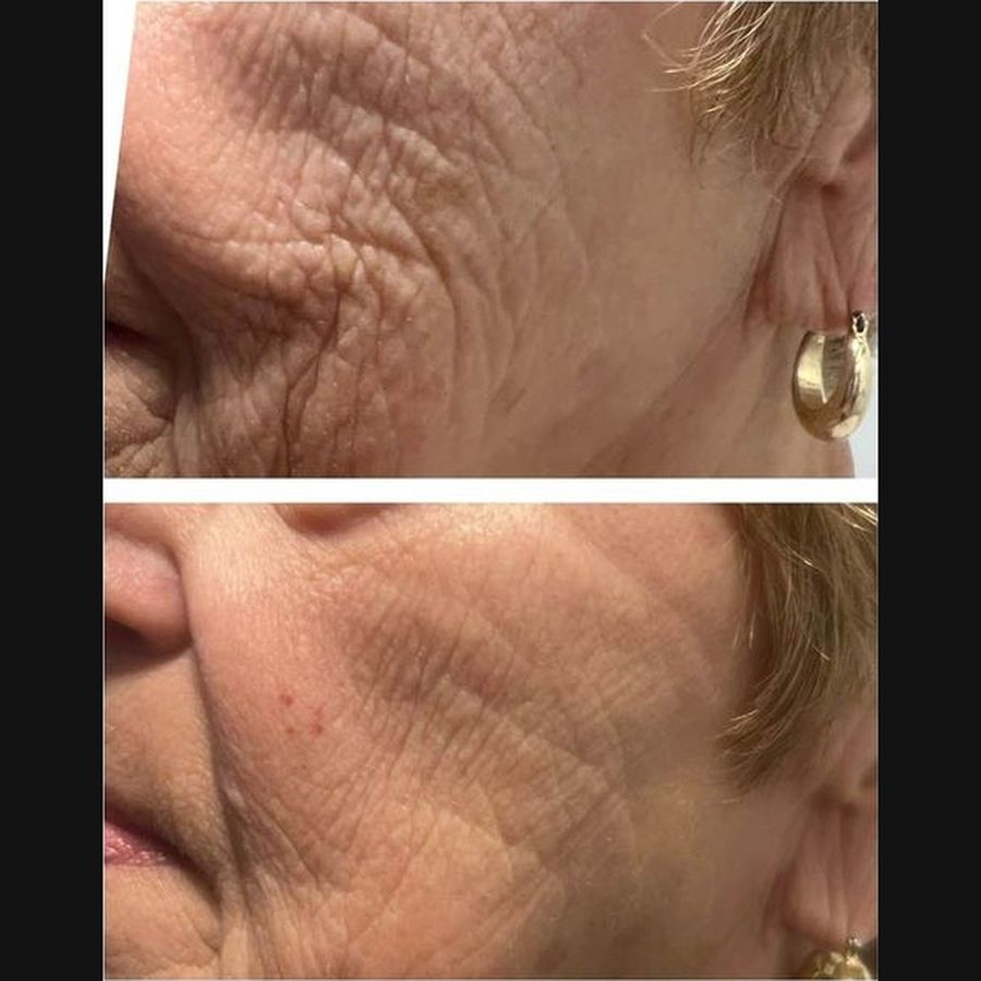 PlasmaChanneling before and after, cheek close up