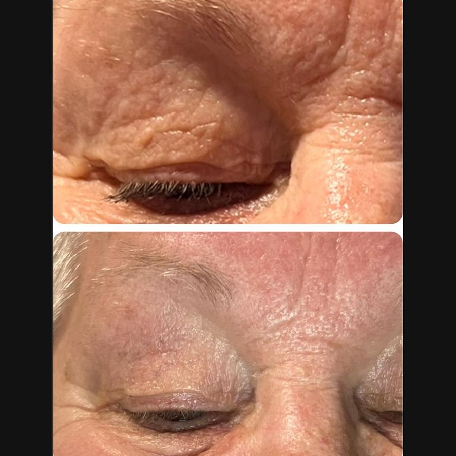 PlasmaChanneling before and after, eyelid close up
