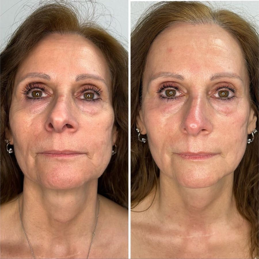 PlasmaChanneling before and after, front view