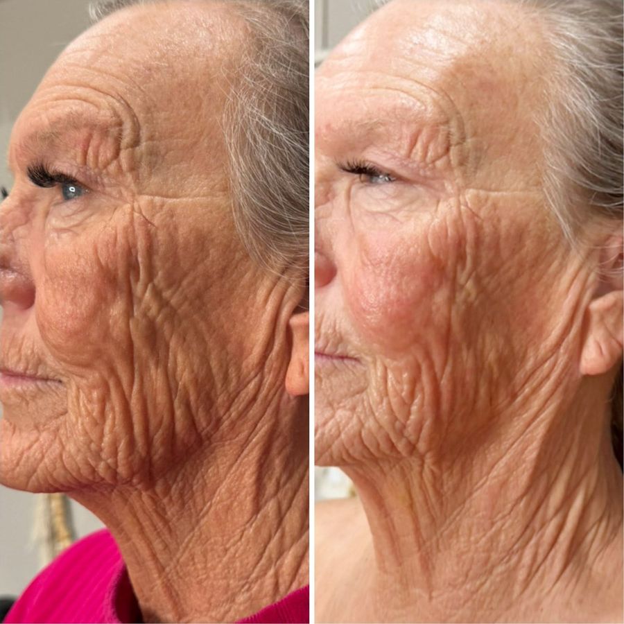 PlasmaChanneling before and after, profile, neck and jaw