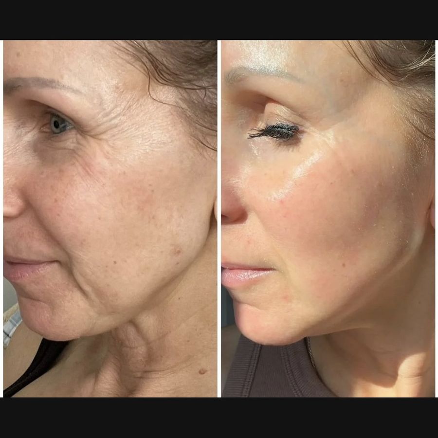 PlasmaChanneling before and after, profile, jawline and neck