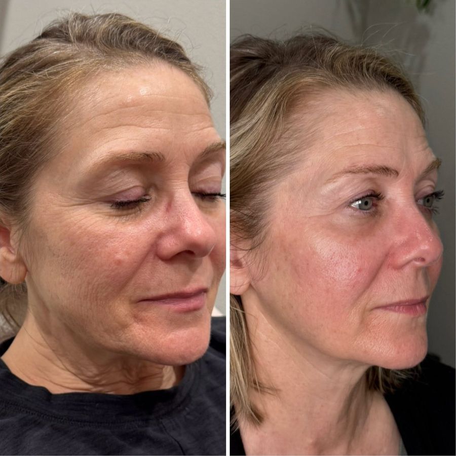 PlasmaChanneling before and after, three-quarter view