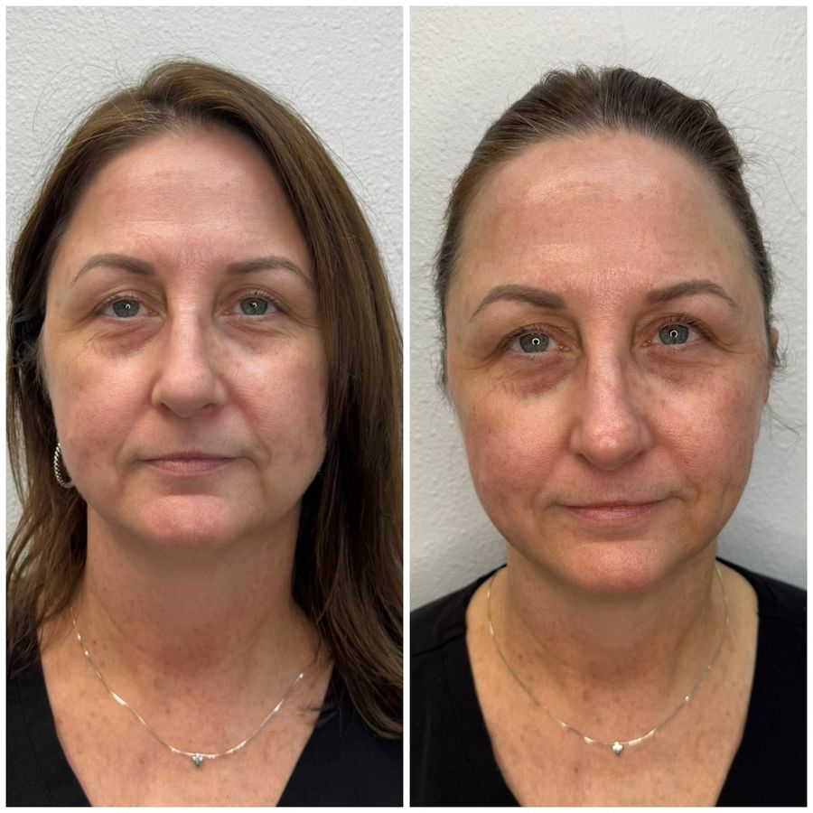 PlasmaChanneling before and after, front view